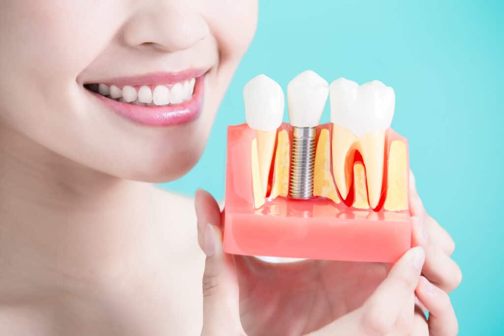 Dental Implants Abbeville