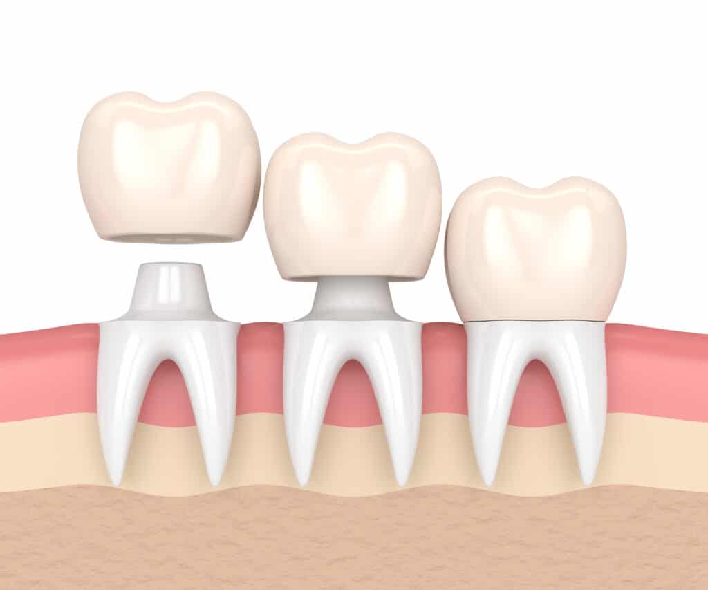 dental crowns