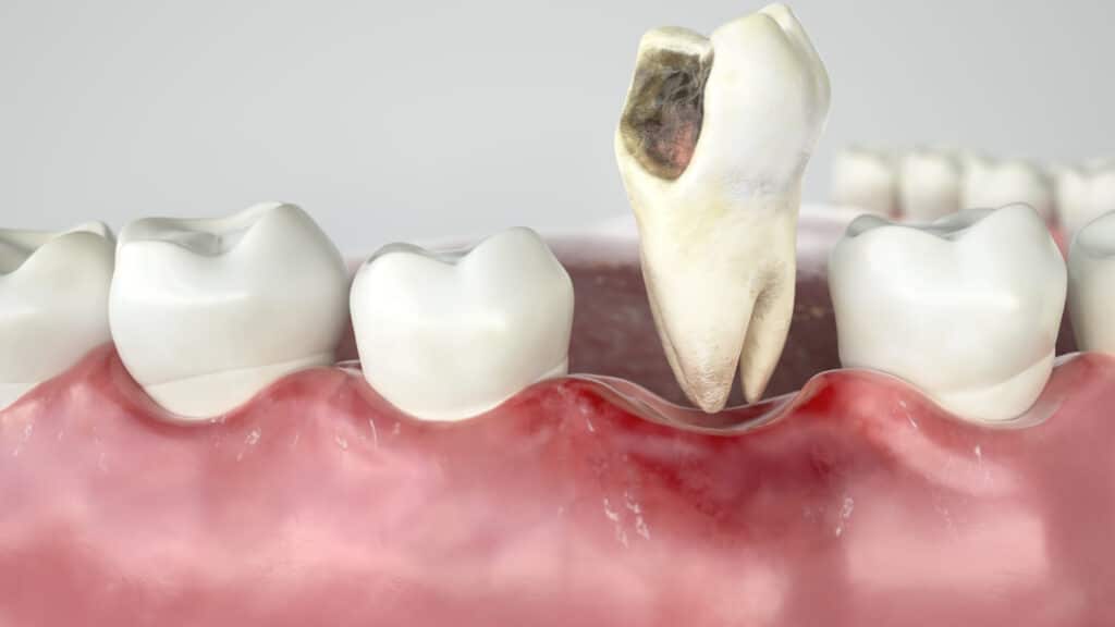 bad tooth being extracted
