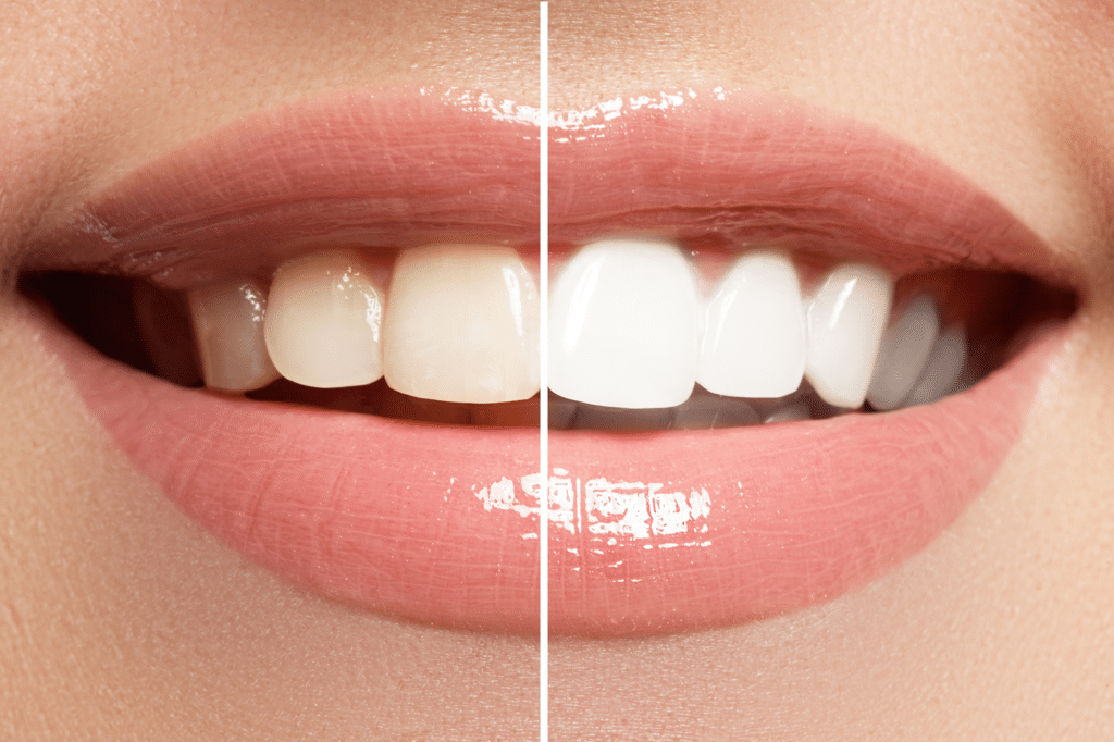 Teeth Whitening vs Veneers Dr. Lance Savoie family dental dentist in abbeville louisiana